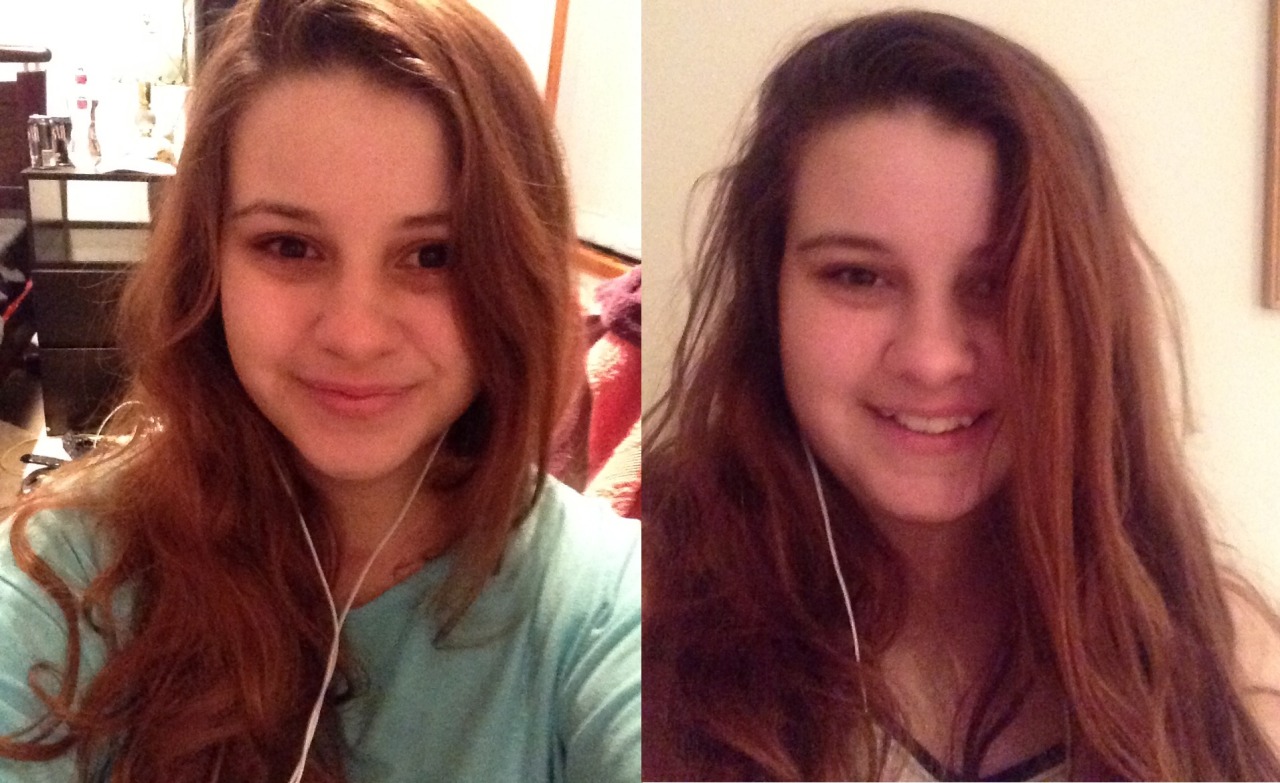 face slimming surgery before and after 7 months