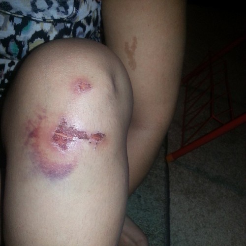 lifeisamazinglycrazy - Day 6 #ouch #rollerderby #kneepads...