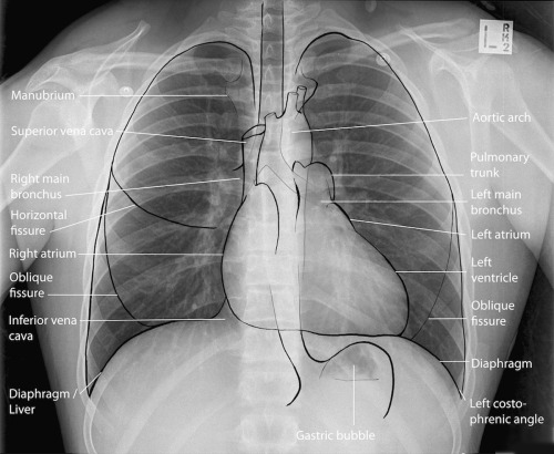 studentparamedics - jewsee-medicalstudent - Normal chest x...