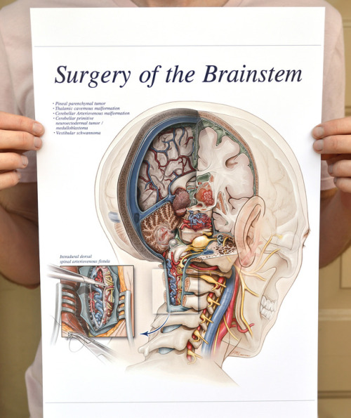skuzz:Surgery of the Brainstem posterPrints available here-...
