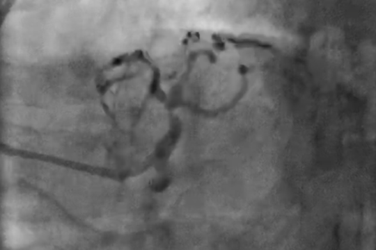 Treating Left Main Lesions: PCI or CABG?