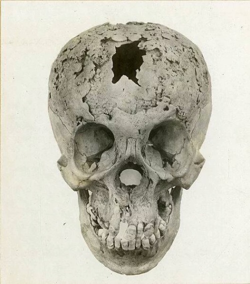 sixpenceee:
“ A human skull with late stage syphilis. It’s is a sexually transmitted disease caused by bacteria, Treponema palladium, and was first described during the Siege of Naples in 1495. It has three stages: primary, secondary, and tertiary....