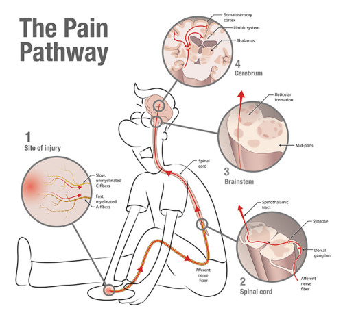 Image result for acute pain