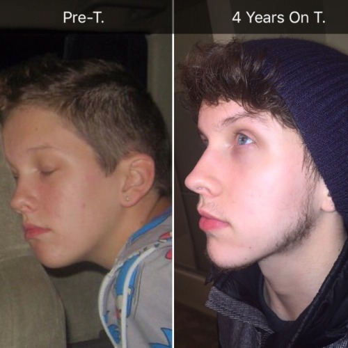ogtruscum:Some comparisons from Pre-T (18 years old) and now /...