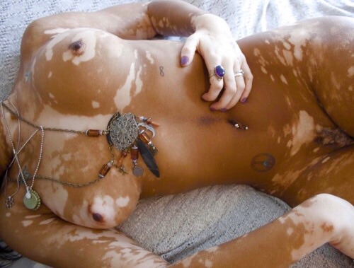 blackgirlsinterracial - This girl with vitiligo is showing...