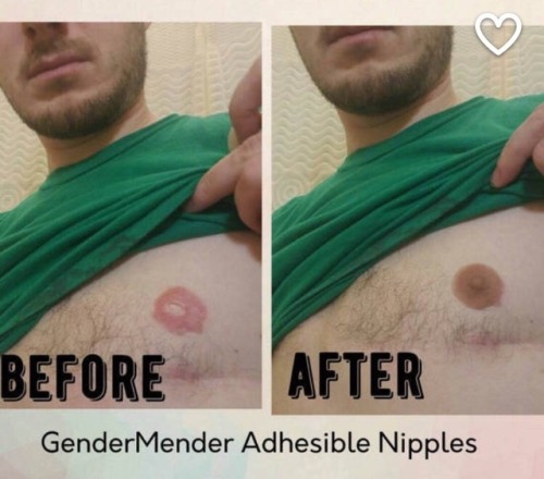 GenderMender ftm prosthetic nipples!Hey guys today I’m going...