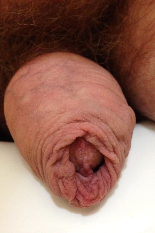 myfavouriteforeskinguys - Acroposthion, a foreskin overhang, is...