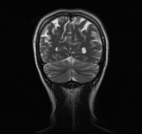 mypsychology - annadraconida - My fave MRI so far.